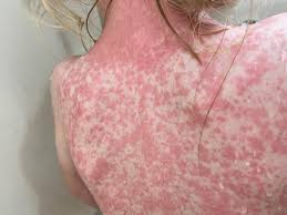 sarampion-en-rd:-un-brote-a-la-vista