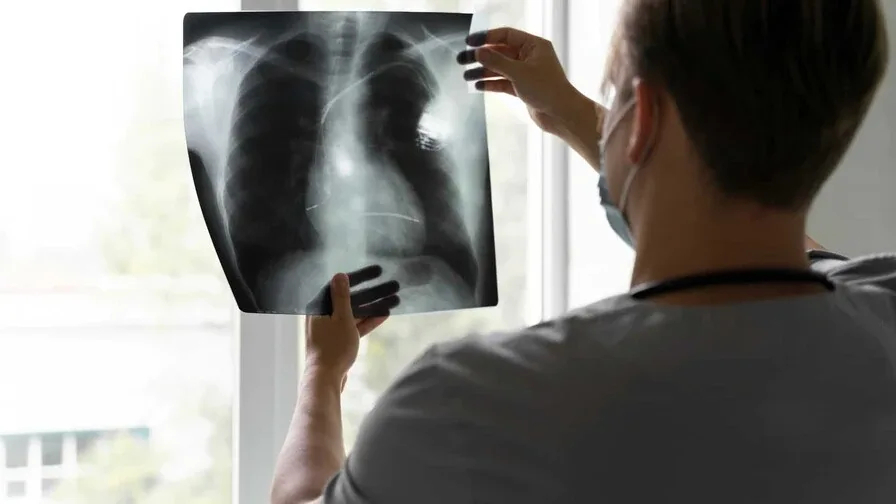 Broncoscopia robótica impulsa diagnósticos más tempranos y seguros del cáncer de pulmón