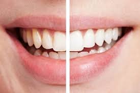 Esperar 30 minutos para cepillarse protege el esmalte dental