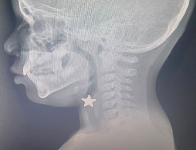 Hospital Pediátrico Dr. Hugo Mendoza salva a niño que aspiró objeto metálico