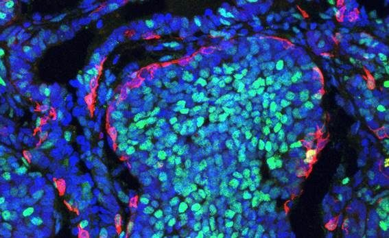 OMS alerta que el cáncer provoca 26 mil muertes diarias y 9.6 millones al año